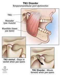 Head Muscles, Neck Ache, Neck Surgery, Hearing Problems, Cleveland Clinic, Mouth Guard, Physical Therapy