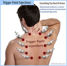 Trigger Point Injections: Everything You Need To Know Trigger Point Injections, Punkty Spustowe, Myofascial Pain Syndrome, Power Plate, Dry Needling, Neck Pain Relief, Neck And Shoulder Pain