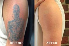 before and after photos of a tattoo removal procedure on a man's left arm