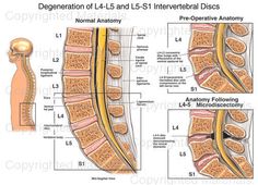 Degeneration of L4-L5 and L5-S1 Intervertebral Discs : Medical Chart Human Body Lesson, Slip Disc, Physician Assistant School, Cauda Equina, Neck Problems, Medical Illustration