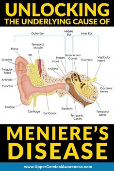 Researchers have spent a century and a half trying to discover what causes Meniere’s disease. What has research revealed thus far? Is there a natural way ... Minears Disease, Menieres Disease Symptoms, Ménière’s Disease, Vestibular Disorder, Meneires Disease, Ear Diseases, Vertigo Relief, Vertigo Remedies, Ear Problems