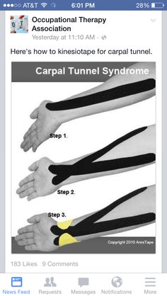 Carpal Tunnel Taping, Kt Tape For Carpal Tunnel, Kt Tape Carpal Tunnel, Carpal Tunnel Kt Taping, Punkty Spustowe, Carpal Tunnel Exercises, Occupational Therapy Assistant