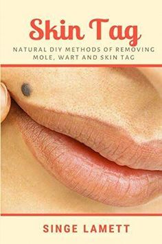 Remove Moles, Skin Natural Remedies