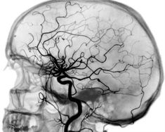 the brain is shown in black and white, with an image of a tree growing out of it