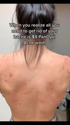 Bad Acne, Healthy Life Hacks, Serious Skin Care, Home Remedy For Cough, Homemade Facials, Acne Remedies, Best Anti Aging