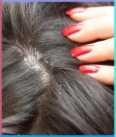 Trichologist Sara Alkazraji, from the UK, has has spoken exclusively to FEMAIL and revealed how common hair and scalp problems can signal underlying health problems. Dry Flaky Scalp, Home Remedies For Dandruff, Thick Hair Remedies, Dandruff Remedy, Getting Rid Of Dandruff, Flaky Scalp, Hair Remedies For Growth, Home Remedies For Hair, Luscious Hair