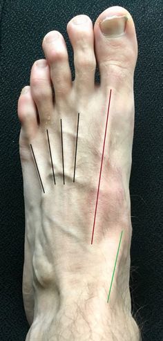 Tibialis anterior tendinopathie – sportmedischnetwerk.nl Tibialis Anterior