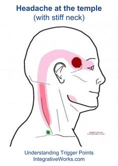 Headache Meaning, Punkty Spustowe, Massage Points, Anatomy Physiology, Stiff Neck, Trigger Point, Chronic Migraines, Migraine Relief