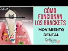 Intrusión Molar con Minitornillos: a propósito de un caso - YouTube Dental School, Dental Humor, Dental Care, Delaware