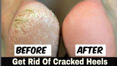 Home remedy for cracked heels. This is an easy home remedy which will help you get rid of cracked heels overnight. It is an easy home remedy for cracked heel... Cracked Feet Remedies, Baking Soda Face Scrub, Overnight Beauty Hacks, Overnight Beauty, Nail Fungus, Health Magazine, Belleza Natural