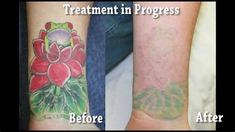 before and after photos of tattoo removals on both arm, the same person has been removed