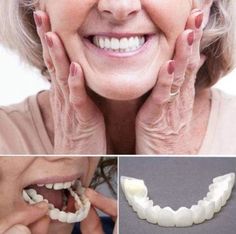 Veneers Teeth, Teeth Braces, Dental Cosmetics, Stained Teeth