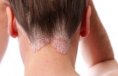 Psoriasis is a skin disease that creates itchy and irritated patches of skin. Read to learn more about the most effective home remedies for scalp psoriasis. Knee Pain Exercises, Vicks Vaporub, Skin Disorders, Hair Remedies, Itchy Skin, Knee Pain, Skin Conditions, Doterra