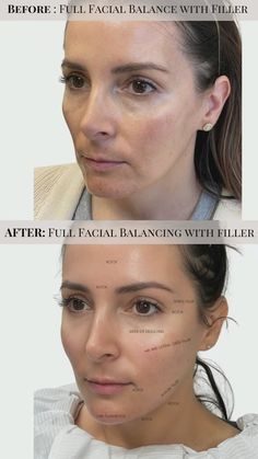 Jill Campbell - Houston Nurse Practitioner | ▪️Treatments Used for Collagen Banking ▪️Instead of reactively treating your skin to recover lost elasticity and collagen, it may be best... | Instagram Radiesse Before After, Lower Face Botox Before And After, Cheek Fillers Before And After Face, Sculptra Filler, Morpheus 8, Face Procedures, Best Collagen