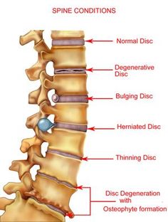 Herniated Disks and Other Spinal Conditions That Can Lead to Sciatica Related Lower Back Pain Bolesti Chrbta, Bulging Disc, Medical Anatomy, Sciatic Nerve, Chiropractic Care, Medical Knowledge