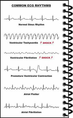 Anesthesia Tech, Ekg Rhythms, Nurse Notes