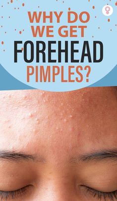 Forehead acne is a condition that affects many men and women worldwide. Learn about its causes, treatment options, and how to prevent it from coming back. Forehead Pimples, Get Rid Of Forehead Acne, Forehead Acne Cause, Forehead Breakout, Pimple Under The Skin, Under The Skin Pimples, Forehead Bumps, Pimples On Forehead, Acne Medicine