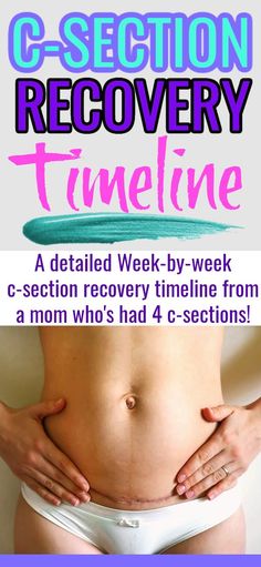 New mom showing how fast she recovered from her c-section and how good her c-section scar looks with these c-section recovery tips and detailed timeline advice. Recovering From C Section, C Section Recovery Timeline, Healing From C Section, Repeat C Section, Breastfeeding After C Section, C Section Scars