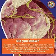 A pinworm infection is a common worm infection in children and those living in close quarters. If a person believes that they have a pinworm infection, it is best to seek medical attention initially. A person can then also try a variety of home remedies, such as coconut oil and garlic, as complementary treatments. Pinworms In Children, Natural Remedies For Migraines, Allergy Remedies, Dry Skin Remedies, Home Remedies For Hair, Natural Antibiotics, Natural Body Care, Cold Home Remedies, Health Habits