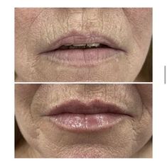 Before and after lip filler, we gave this lovely patient some volume and kept her lips looking natural After Pictures, Before And After Pictures