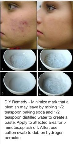 #DIY Remedy- Minimize a mark that a blemish may leave by mixing 1/2 tsp baking soda and 1/2 tsp distilled water to create a paste. Apply for 5 minutes, splash off. After use a cotton swab to dab hydrogen peroxide. Make Up Diy, How To Reduce Pimples, Clear Skin Tips, Baking Soda Shampoo, Diy Remedies, Makijaż Smokey Eye, Pimple Marks, Beauty Remedies, Acne Remedies