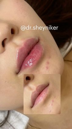 #lip#lipfillersbeforeandafter #lipfillersstyles #lipfiller #lips#augmentation#увеличениегуб#губымосква Asian Lip Filler, Round Lips, Face Plastic Surgery, Black Girls Luxury Lifestyle, Lip Combos, Cheek Fillers, Lip Augmentation