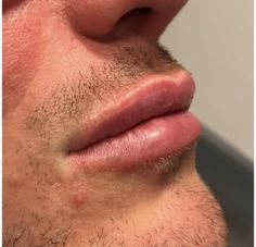 Lip filler is not just for the ladies! We also treat men. Iron Man