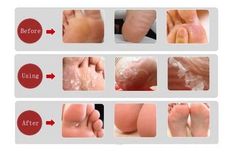 Get Soft Feet with This Efficient Method Feet Peeling Remedies, Dry Feet Remedies Dead Skin, Dry Peeling Feet Remedy, Feet Exfoliation Diy, How To Stop Feet From Peeling, Peeling Skin, Skin Remedies, Homemade Remedies, Diy Health