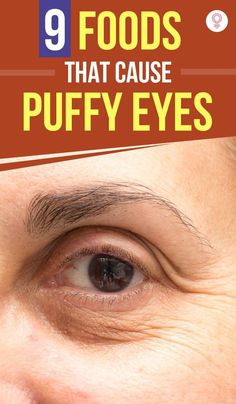 9 Foods That Cause Puffy Eyes: If you feel like no matter how much water you drink, you just cannot get rid of those pesky puffy eye bags, here are a couple of foods that might be causing them. Consider skipping these food items in your next few meals and see the difference it makes to your skin. Itchy Eyelids, Vitamin Brands, Natural Eye Makeup Tutorial, Bulging Eyes