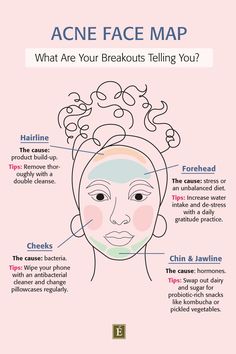 Pimple Chart, Face Acne Remedies, Acne Chart, Acne Face Map, Face Map, Blind Pimple, Forehead Acne, Pimples Under The Skin