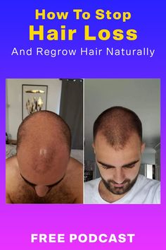 Free podcast discussing how to stop hair loss and regrow hair naturally Regrow Hair Naturally, Total Workout, Regrow Hair, Wait What, Life Force Energy, Let Your Hair Down, Cardiovascular Disease, Hair Health, Down Hairstyles