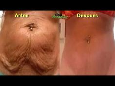 Este truco chupa la grasa como loco y Elimina la piel Flácida del abdomen en tan sólo una Noche. - YouTube Skin Tightening Stomach, Tighten Loose Skin, Tighter Skin, Saggy Skin, Skin Remedies, Loose Skin, Sagging Skin, Skin Care Women, Skin Tightening