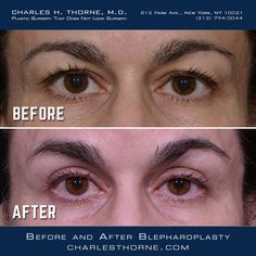 Before and after upper Blepharoplasty by Dr. Thorne. https://charlesthornemd.com/face-surgery/blepharoplasty-eyelid-surgery.html - - #cosmeticsurgery #plasticsurgery #facelift #beforeandafter #plasticsurgeon #beauty #nyc #bestplasticsurgeon #newyork #facelift #surgery #transformation #beforeandafter #blepharoplasty #doctor #boardcertifiedplasticsurgeon #eyes #eyelidsurgery #realpatients #cosmeticsurgeon #realresults #topplasticsurgeon #charlesthornemd #eyelids Fine Wrinkles