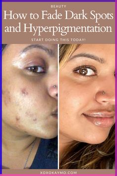 How to Fade Dark Spots and Hyperpigmentation Acne happens, and sometimes we have the scars left over to prove it. If you have darker skin tones, acne blemishes tend to linger long after the pimple disappears. There are products and methods you can implement today to get rid of these dark spots and hyperpigmentation quick. How To Remove Blemishes From Face, How To Get Rid Of Acne And Dark Spots, Hyper Pigmentation On Face, Best Skin Care Products For Acne Dark Spots, Pimple Scar Removal Dark Spots, Dark Acne Spots Remedies, How To Remove Hyperpigmentation On Face, Blemishes On Face Remedies, How To Fade Acne Marks