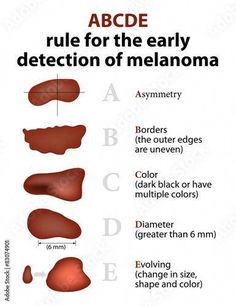 the different types of melanona are labeled in this diagram, including red and orange