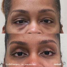 Hooded Eye Surgery, Eye Bag Surgery, Eye Lift Surgery, Get Rid Of Eye Bags, Rid Of Eye Bags, Hooded Eyelids, Eye Makeup Application