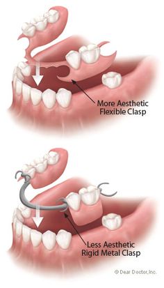 Types of flexible partial dentures. Dental Assistant Study, Kedokteran Gigi, Partial Dentures, Tooth Replacement, Teeth Health