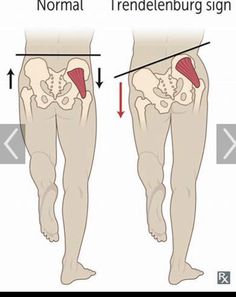 Gluteus Medius Exercises, Hip Strengthening Exercises, Glute Medius, Knock Knees, Lower Back Pain Exercises, Gluteus Medius, Posture Exercises, Knee Exercises, Hip Muscles