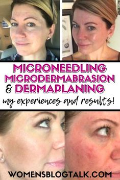 Microbrasion Facial, At Home Microdermabrasion, Before And After Microneedling, Microplaning Face, Microabrasion Facial, Dr Pen Microneedling Before And After, Microdermabrasion Before And After, Dermabrasion Before And After, Micro Needling Before And After