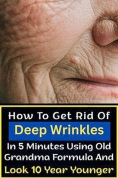 "Facial Line Liberation: Achieve Smooth Skin in a Week!" #AgelessRadiance #YouthfulForever #SmoothOperator #BeautyUnbound #WrinkleDefense Wrinkle Free Skin, Skin Remedies, Deep Wrinkles, Sagging Skin, Years Younger