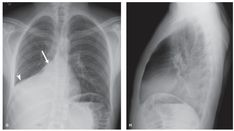 an x - ray shows the chest and ribs, with two different views of it