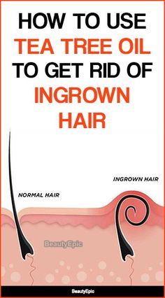 Ingrowing Hair, Infected Ingrown Hair, Tee Tree Oil, Ingrown Hair Remedies, Tea Tree Oil Uses, Ingrown Hair Removal, Hair Tea, Hair Removal Diy, Pimples Remedies