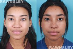 African American Rhinoplasty, Nose Operation Before After, Rhinoplasty Results, Turkish Rhinoplasty, Rynoplasty Surgery, Ethnic Rhinoplasty African Americans, Nose Surgery Before And After, Alarplasty Before After, Nose Tip Surgery Before After