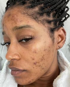 Skin Health begins with Education!HYPERPIGMENTATION is, unfortunately, becoming normal in African, Indian, Pacific Islander,  Native American, Hispanic peopl... Girl With Acne, Pacific Islander, Acne Causes, Best Serum, Brighten Skin Tone