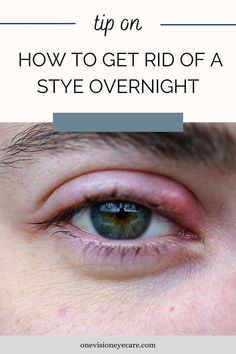 How to get rid of a stye quickly overnight and other important information about styes. How we get them, why we get them, and tips on styes. Eye Infection Remedies, Stye Remedies, Eye Stye Remedies, Face Cleaner, Eye Infections, Type Treatments, Vision Eye, Back Pain Exercises, Healthy Liver