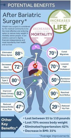 Potential Benefits after Bariatric Surgery #HowToLoseStubbornBellyFat Bariatric Friendly Recipes, Lost 50 Pounds, Tea Burn, Obese People, Lose 15 Pounds, 50 Pounds