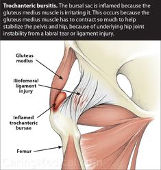 Greater trochanteric pain syndrome and bursitis treatment – Caring Medical Florida Femoroacetabular Impingement, Greater Trochanteric Pain Syndrome, Snapping Hip Syndrome, Hip Impingement, Hip Injury, Bursitis Hip, Hip Fracture, Hip Problems