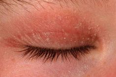 Learn about eyelid dermatitis, including types, causes, symptoms, and prevention, and how to get rid of these itchy, dry eyelid rashes.