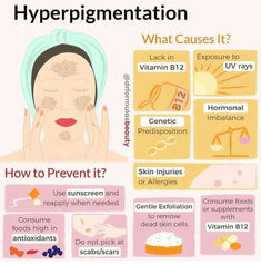 #hyperpigmentation #hyperpigmentationtreatment #howtogetridofhyperpigmentation Serum For Dry Skin, Skin And Hair Clinic, Facial Tips, Skin Care Business