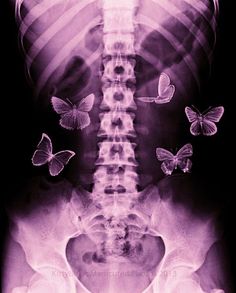 an x - ray shows butterflies flying around the neck